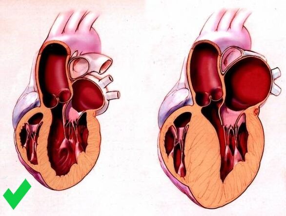 Cardione previne hipertrofia ventriculară a inimii